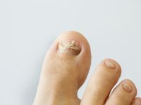 Nail Issues? | Toe Fungus | Get Best Treatment Remedies