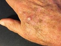 atrophic actinic keratosis